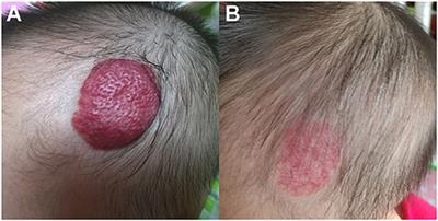 Topical Timolol Vs. Oral Propranolol for the Treatment of Superficial Infantile Hemangiomas